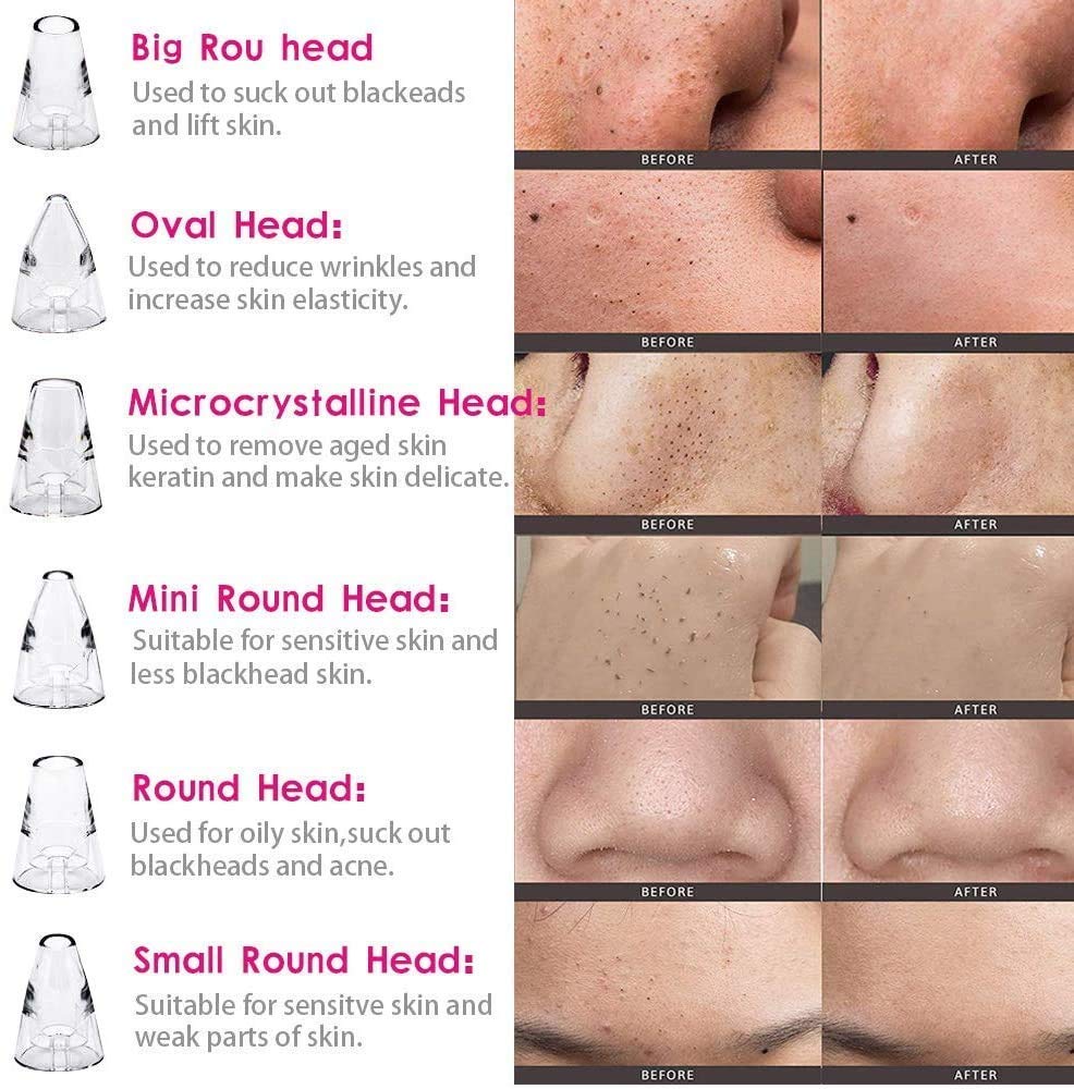 Vacuum Suction Blackhead